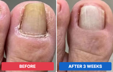 Martin, CA before and after 3 weeks