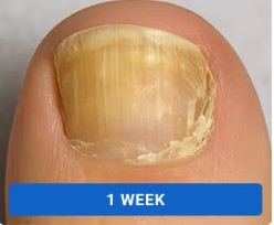 Toenail clearing progression with Orivelle - week 1