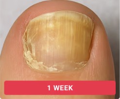 Toenail fungal progression without treatment - week 1