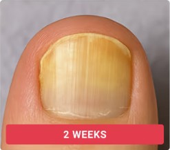 Toenail fungal progression without treatment - week 2