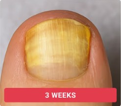 Toenail fungal progression without treatment - week 3